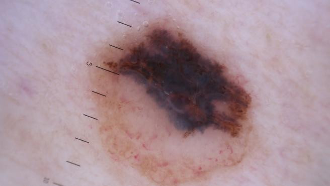 Melanoma