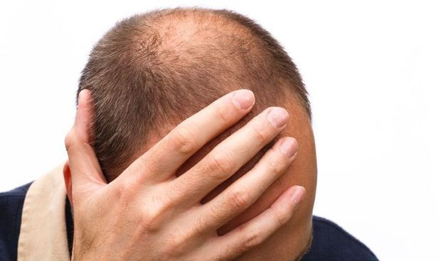 Covid alopecia androgenica estudio mayor gravedad 5730 620x368
