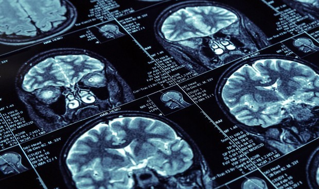 Covid persistente secuelas neurocognitivas 12 semanas 6673 620x368