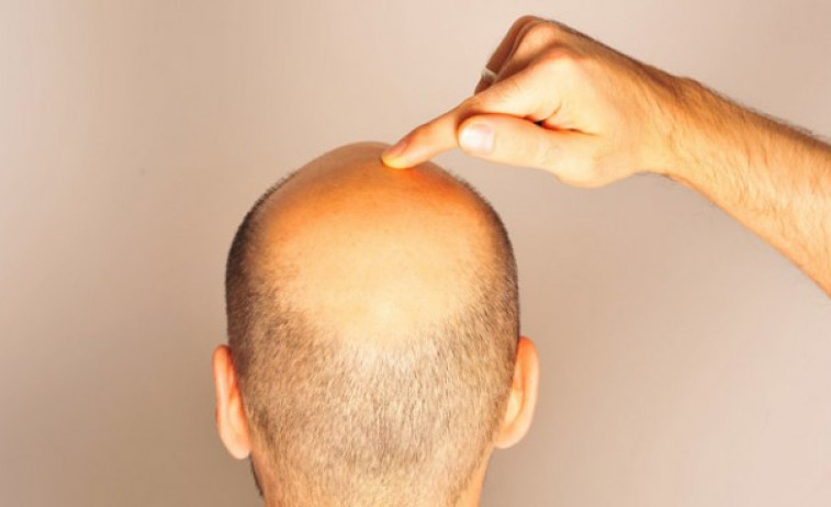 La alopecia androgénica no se relaciona con síntomas depresivos