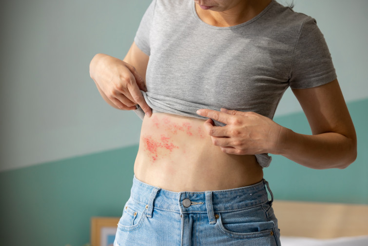 ¿Sabías que el estrés excesivo puede reactivar el herpes zóster?