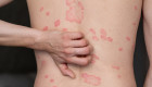 El impacto oculto de la psoriasis: más allá de una enfermedad en la piel