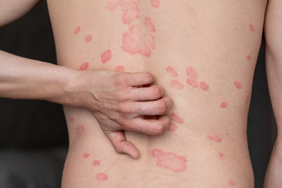 El impacto oculto de la psoriasis: más allá de una enfermedad en la piel