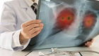 La OMS alerta sobre medicamento falsificado para tratar el cáncer de pulmón no microcítico