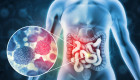 Cáncer colorrectal: ponga atención a cuatro  síntomas primordiales