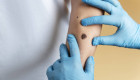 Inmunoterapia, el tratamiento clave contra los melanomas
