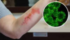 Cero mariscos crudos: Sociedad infectología emite recomendaciones por bacteria carnívora