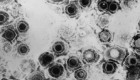 Descubren un antiviral contra el herpes que vence la resistencia a las curas actuales