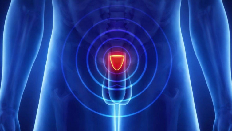 Un nuevo dispositivo de terapia láser logra controlar el cáncer de próstata con menos secuelas