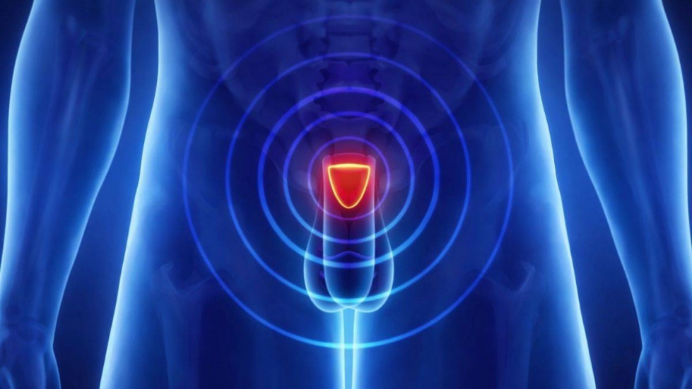 Un nuevo dispositivo de terapia láser logra controlar el cáncer de próstata con menos secuelas